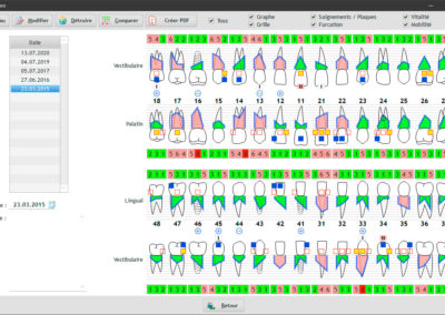 Vue détaillée du schéma parodontal dans le logiciel EasyGest d'un patient avec les valeurs vestibulaires, palatin et lingual