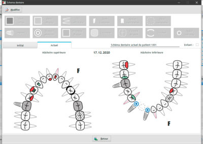 Le schéma dentaire peut être géré graphiquement par simple clic dans le logiciel suisse EasyGest pour les dentistes.